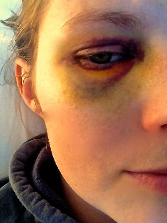 Laura's black eye was the result of an accidental elbow to the face during a game of football. (Image: Laura Wynne)